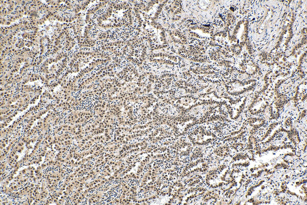 Immunohistochemistry (IHC) staining of human lung cancer tissue using CDC2L1 Polyclonal antibody (28613-1-AP)