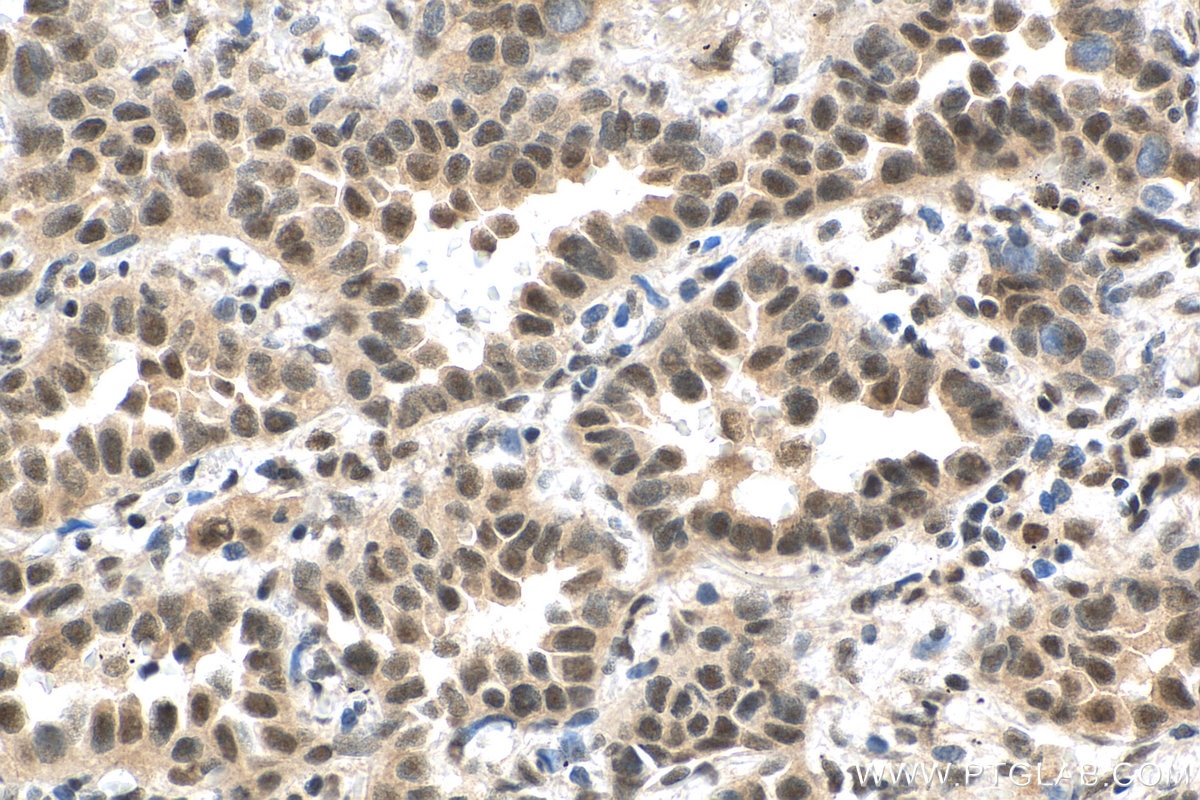 Immunohistochemistry (IHC) staining of human lung cancer tissue using CDC2L1 Polyclonal antibody (28613-1-AP)