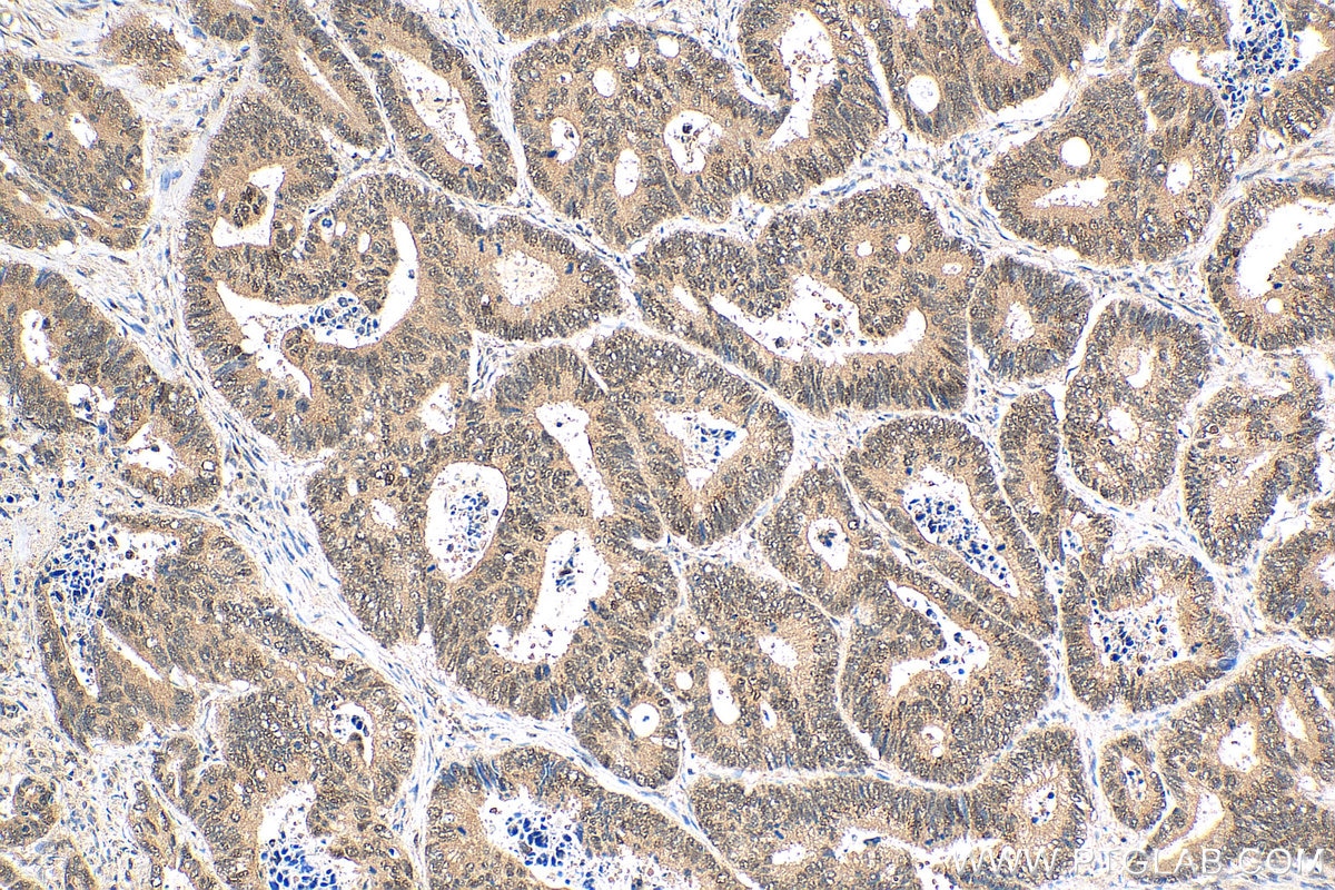Immunohistochemistry (IHC) staining of human colon cancer tissue using CDC2L1 Polyclonal antibody (28613-1-AP)
