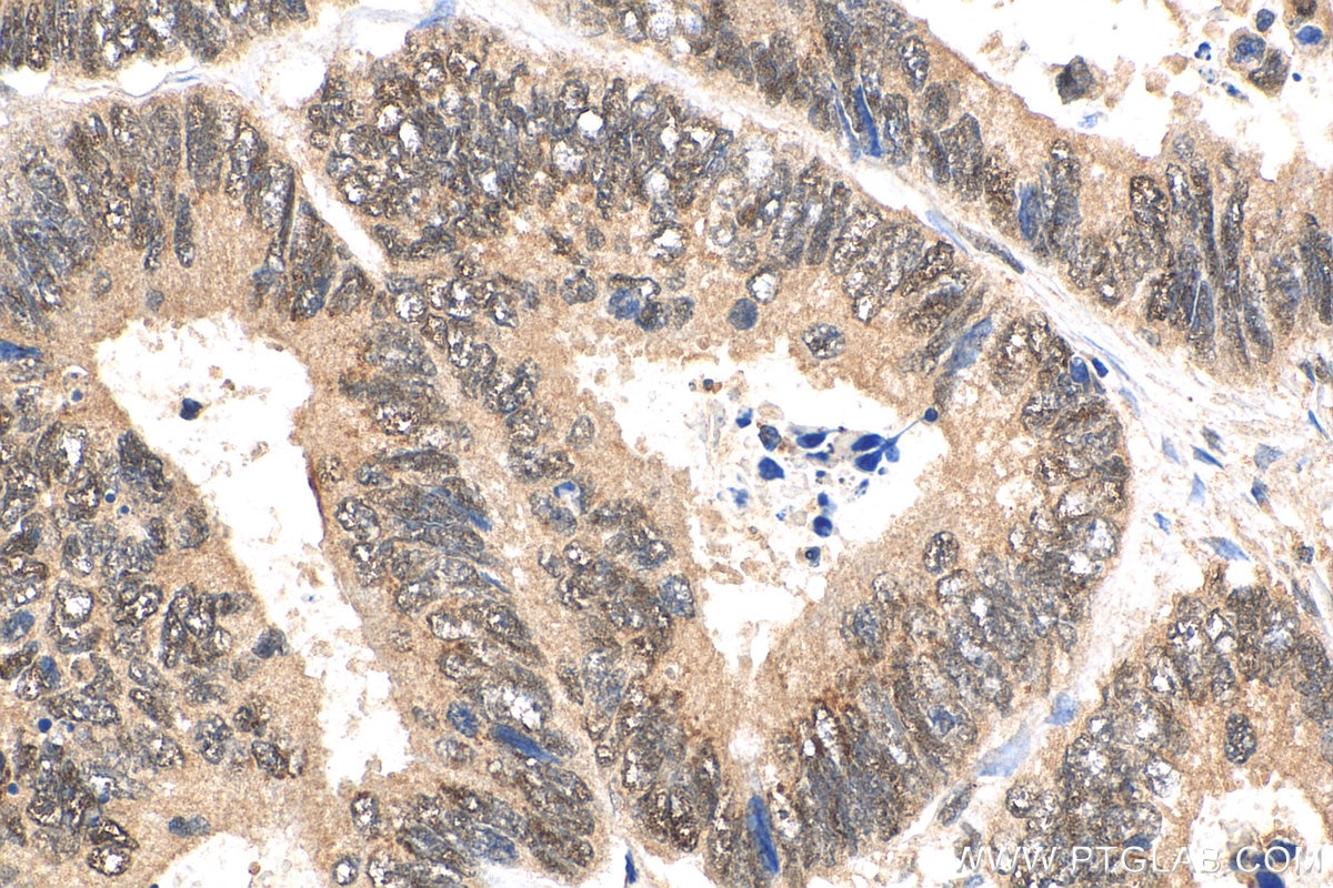 Immunohistochemistry (IHC) staining of human colon cancer tissue using CDC2L1 Polyclonal antibody (28613-1-AP)