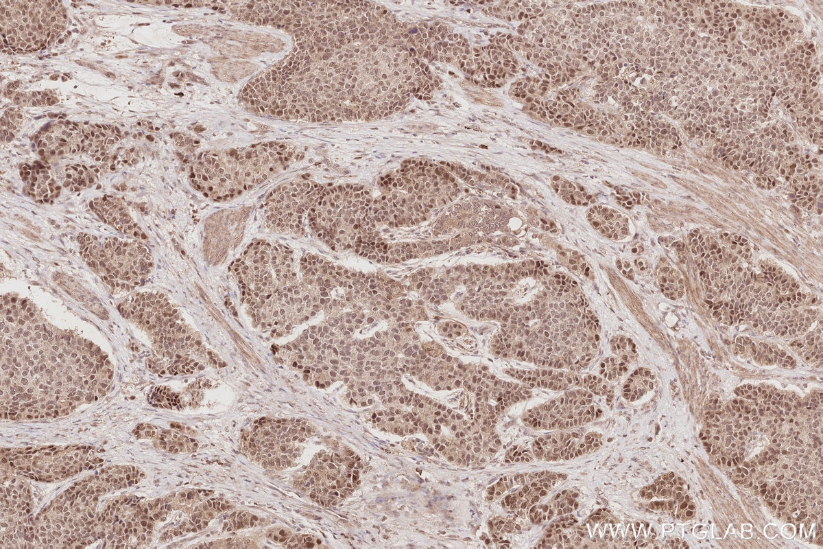 Immunohistochemistry (IHC) staining of human stomach cancer tissue using CDK8/19 Polyclonal antibody (13761-1-AP)