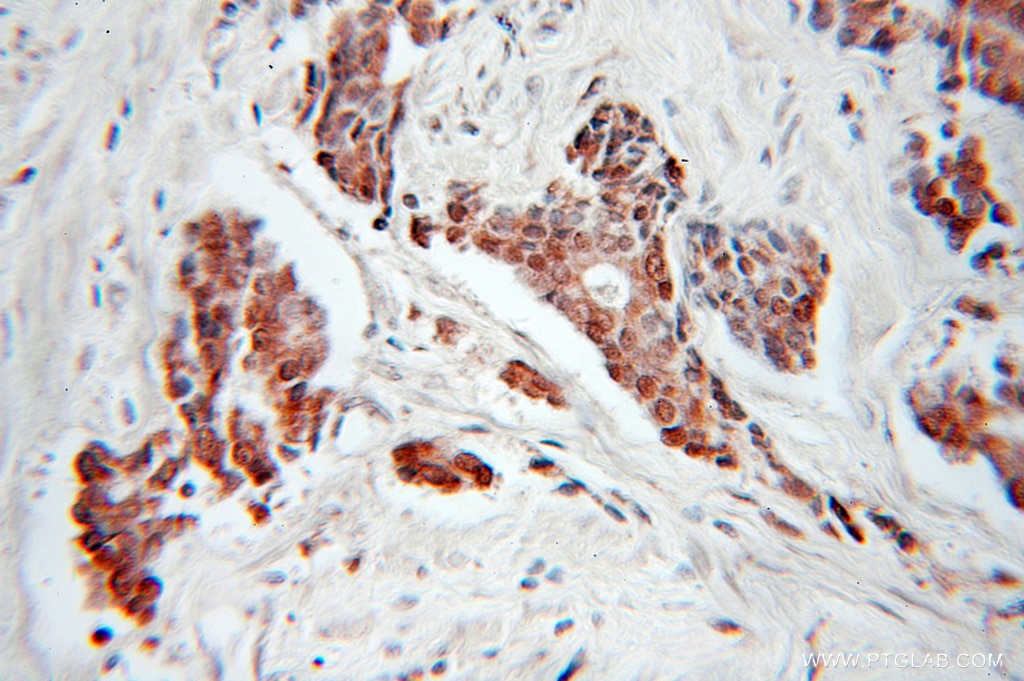 Immunohistochemistry (IHC) staining of human prostate cancer tissue using CDC34 Polyclonal antibody (10964-2-AP)