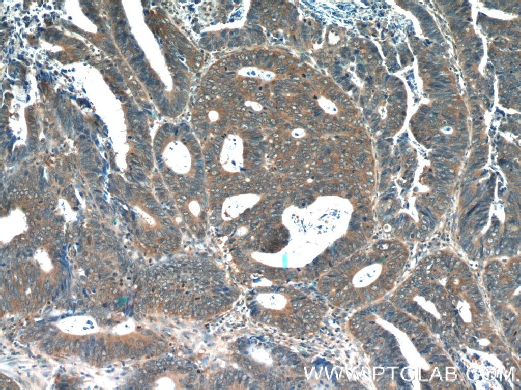 Immunohistochemistry (IHC) staining of human colon cancer tissue using CDC37 Polyclonal antibody (10218-1-AP)