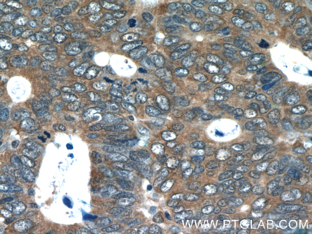 Immunohistochemistry (IHC) staining of human colon cancer tissue using CDC37 Polyclonal antibody (10218-1-AP)