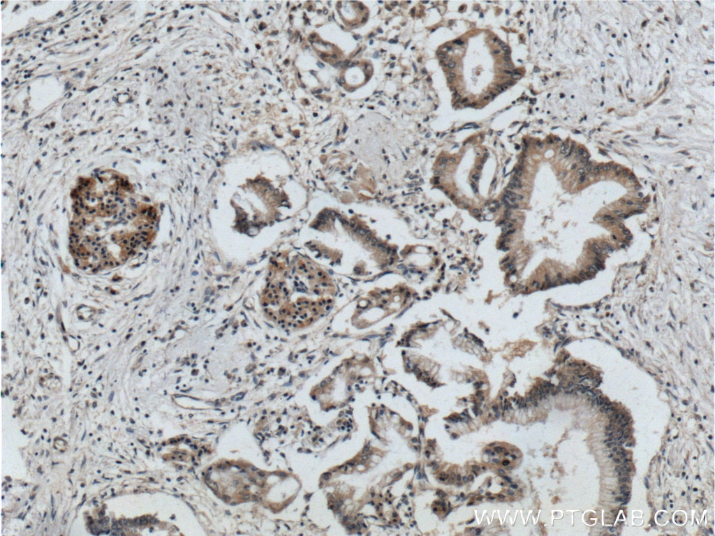 Immunohistochemistry (IHC) staining of human pancreas cancer tissue using CDC42 Polyclonal antibody (10155-1-AP)