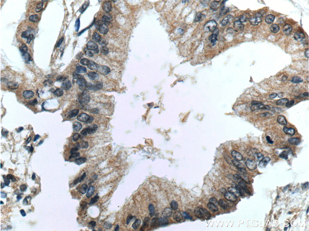 Immunohistochemistry (IHC) staining of human pancreas cancer tissue using CDC42 Polyclonal antibody (10155-1-AP)