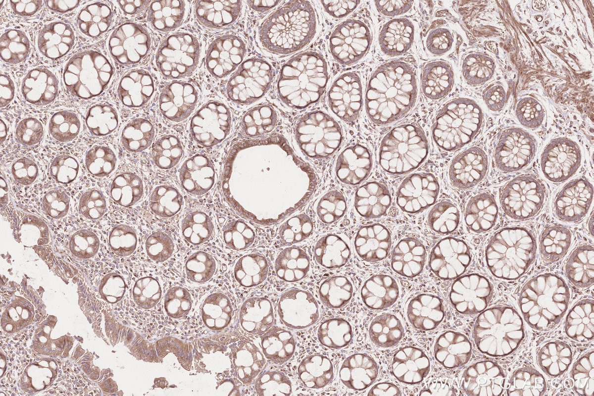 IHC staining of human rectal cancer using 31297-1-AP Immunohistochemistry (IHC) staining of human rectal cancer tissue using CDC42BPA Polyclonal antibody (31297-1-AP)