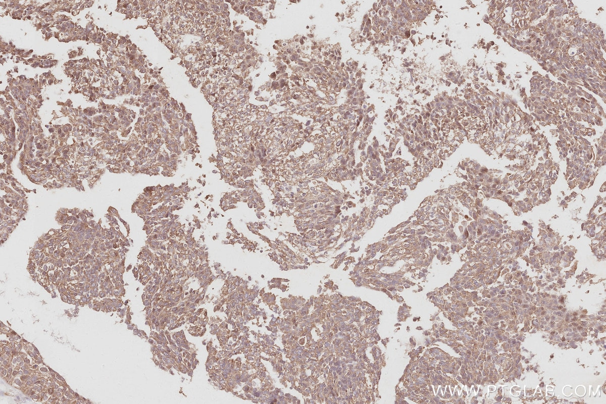IHC staining of human ovary cancer using 31526-1-AP Immunohistochemistry (IHC) staining of human ovary cancer tissue using CDC42BPB Polyclonal antibody (31526-1-AP)