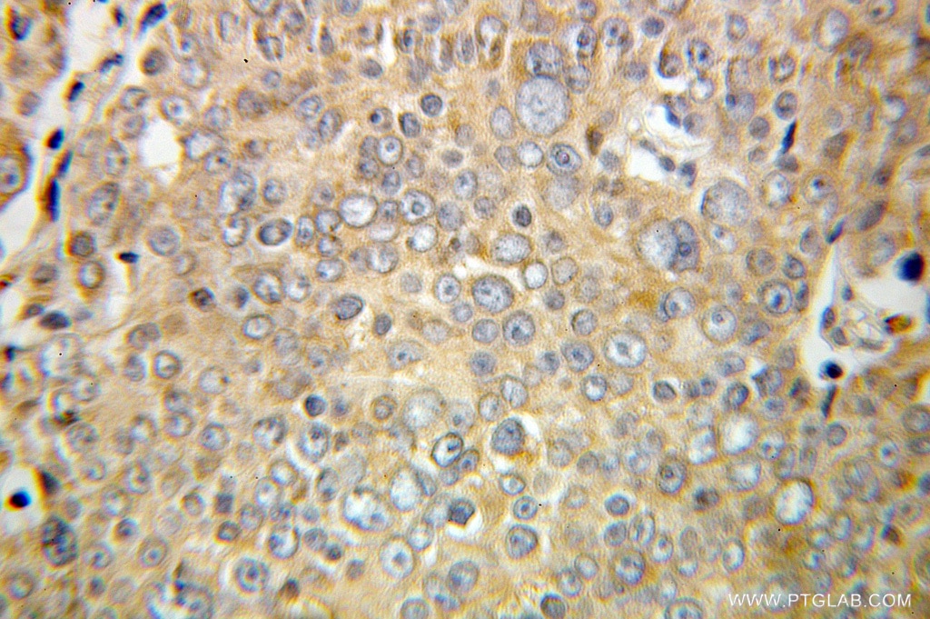 Immunohistochemistry (IHC) staining of human prostate cancer tissue using CDC42EP3 Polyclonal antibody (10780-1-AP)