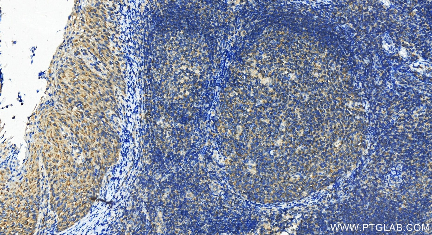 Immunohistochemistry (IHC) staining of human tonsillitis tissue using CDC42SE1 Polyclonal antibody (12427-1-AP)
