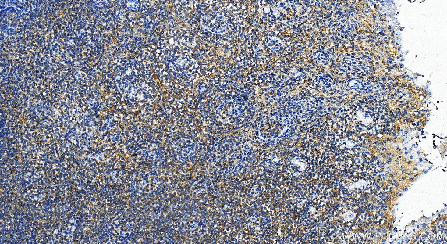 Immunohistochemistry (IHC) staining of human tonsillitis tissue using CDC42SE1 Polyclonal antibody (12427-1-AP)
