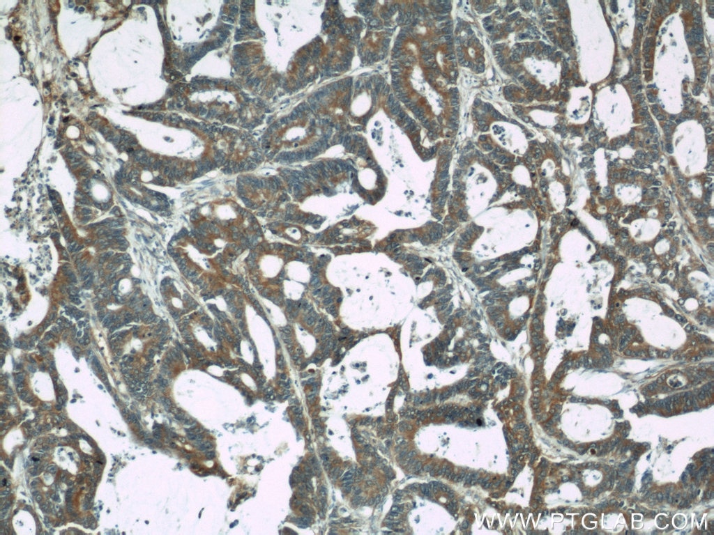 Immunohistochemistry (IHC) staining of human colon cancer tissue using CDC6 Polyclonal antibody (11640-1-AP)