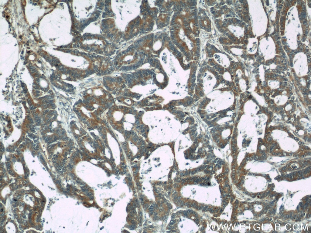 IHC staining of human colon cancer using 11640-1-AP