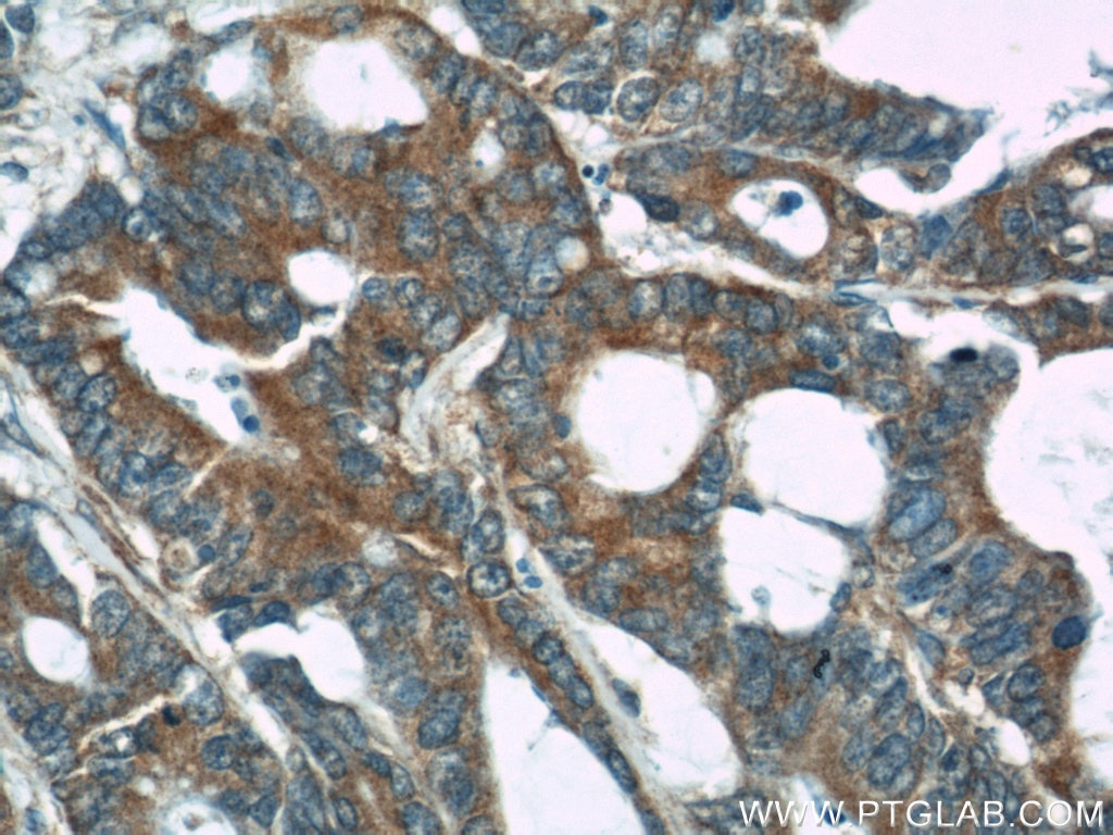 Immunohistochemistry (IHC) staining of human colon cancer tissue using CDC6 Polyclonal antibody (11640-1-AP)