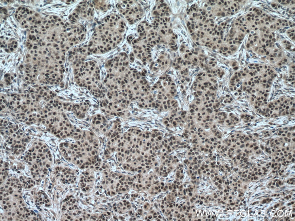 Immunohistochemistry (IHC) staining of human breast cancer tissue using HRPT2, CDC73 Polyclonal antibody (12310-1-AP)