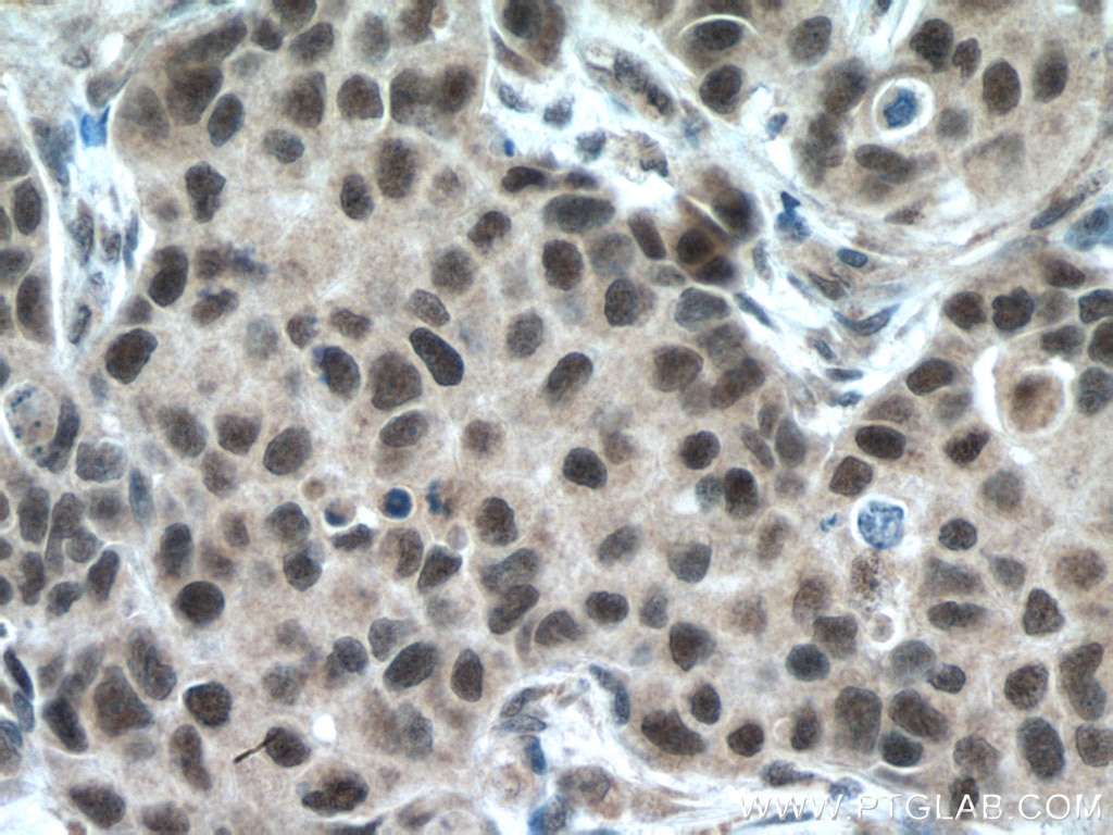 Immunohistochemistry (IHC) staining of human breast cancer tissue using HRPT2, CDC73 Polyclonal antibody (12310-1-AP)