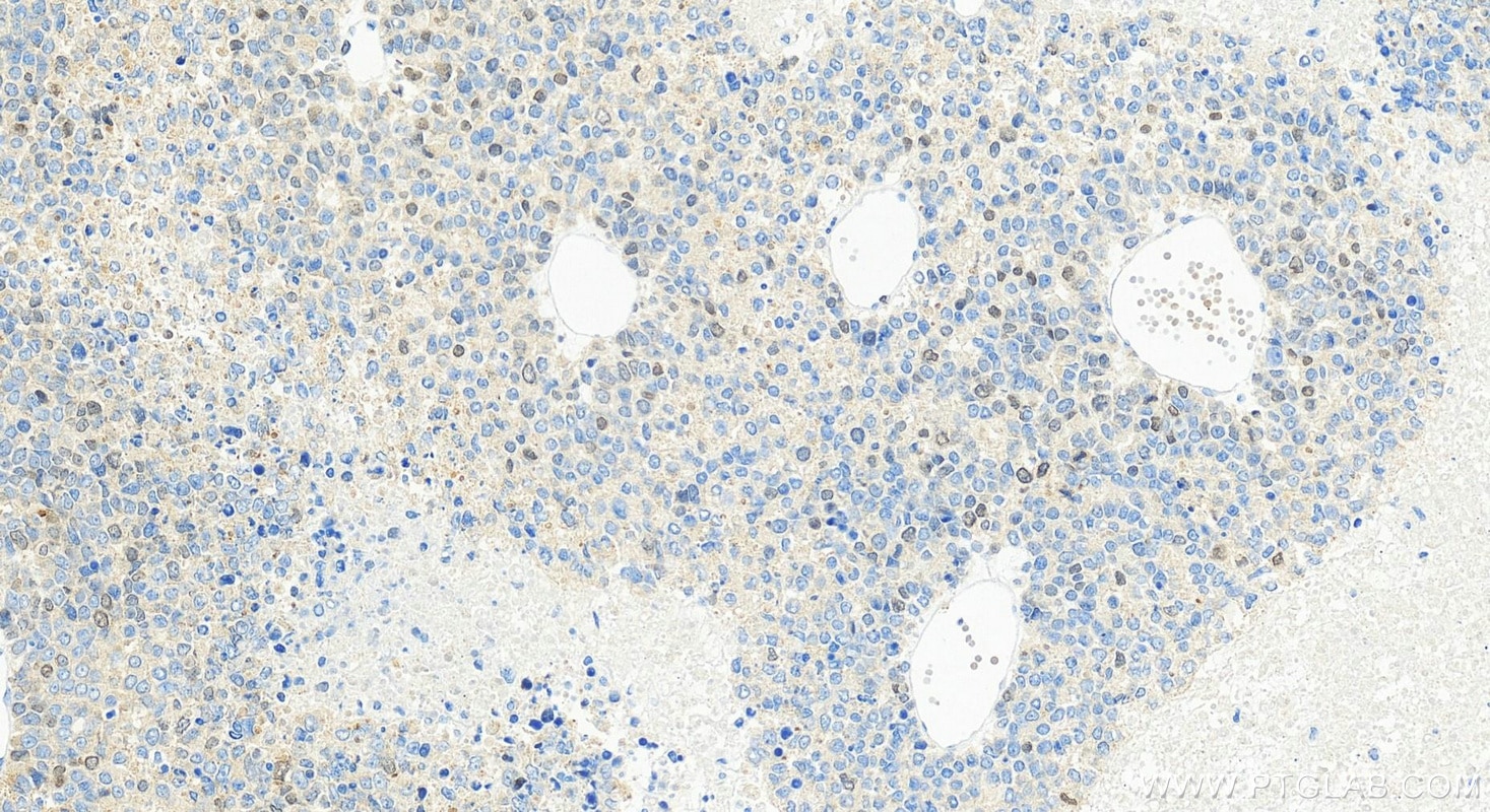 Immunohistochemistry (IHC) staining of Hepatocellular carcinoma tissue using CDCA2 Recombinant monoclonal antibody (86379-1-RR)