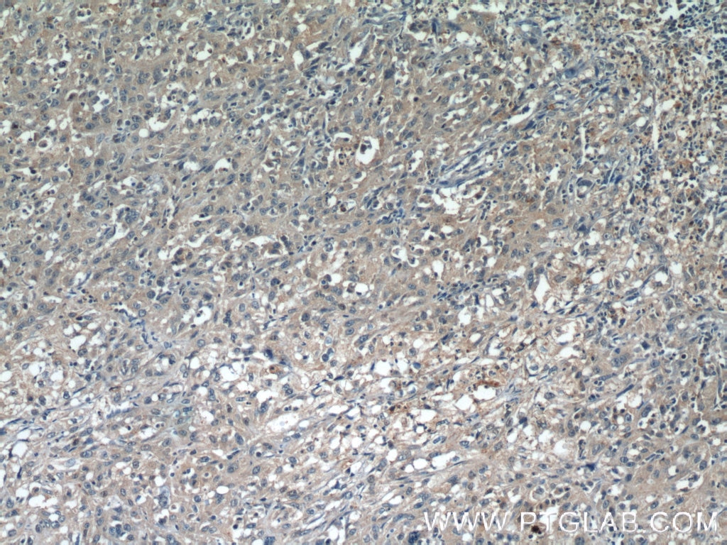 Immunohistochemistry (IHC) staining of human cervical cancer tissue using CDCA3 Polyclonal antibody (15594-1-AP)
