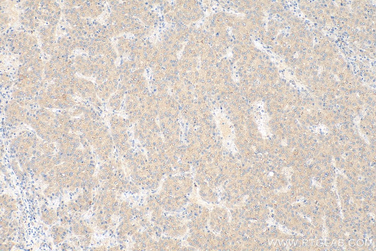 Immunohistochemistry (IHC) staining of human liver cancer tissue using CDCA3 Polyclonal antibody (15594-1-AP)