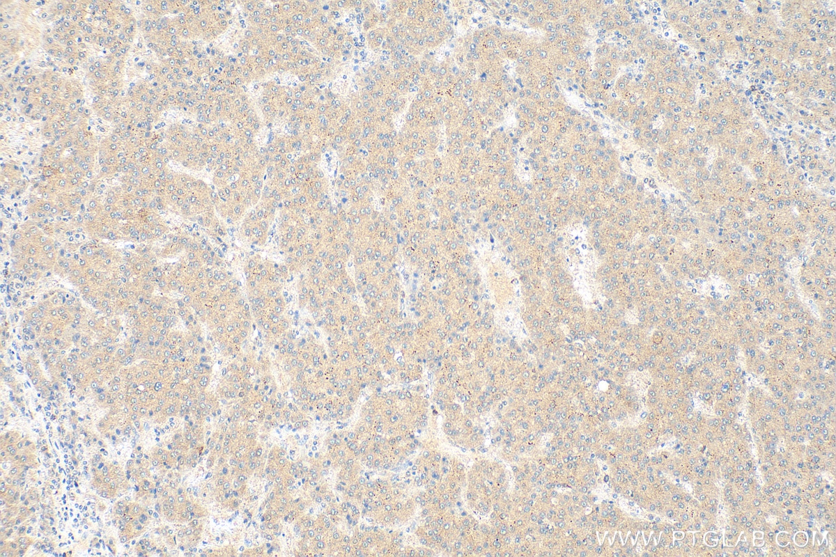 IHC staining of human liver cancer using 15594-1-AP