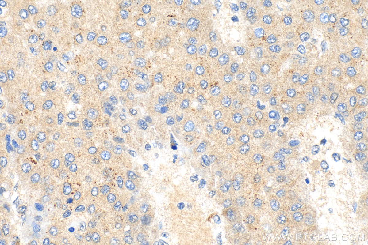 IHC staining of human liver cancer using 15594-1-AP