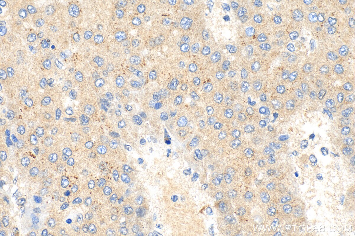 Immunohistochemistry (IHC) staining of human liver cancer tissue using CDCA3 Polyclonal antibody (15594-1-AP)