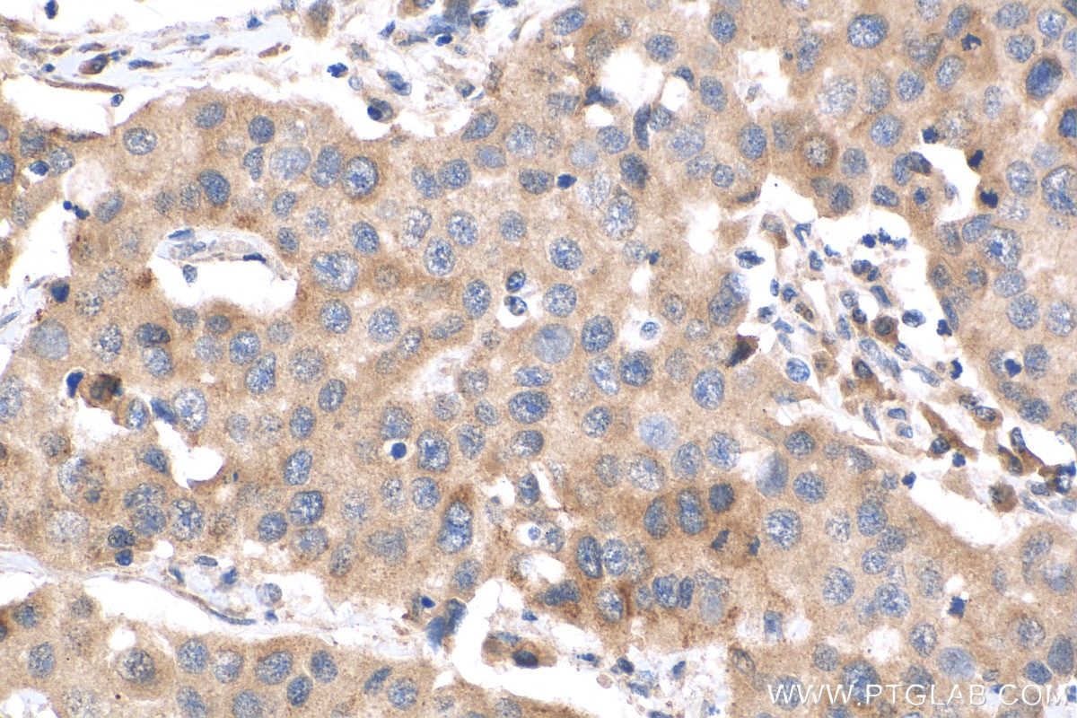 Immunohistochemistry (IHC) staining of human breast cancer tissue using CDCA3 Polyclonal antibody (15594-1-AP)