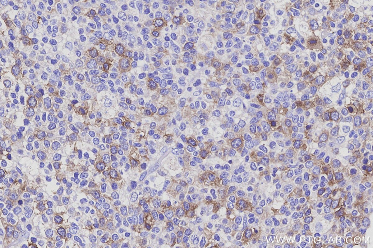 Immunohistochemistry (IHC) staining of human tonsillitis tissue using CDCA3 Polyclonal antibody (15594-1-AP)