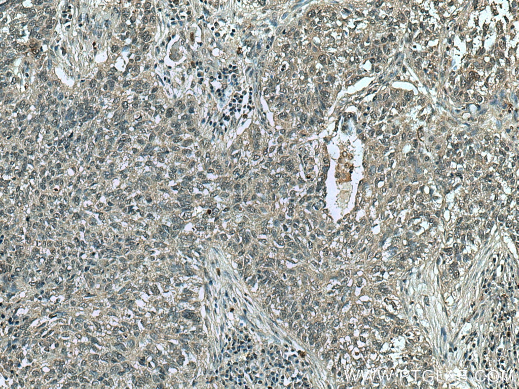 Immunohistochemistry (IHC) staining of human lung cancer tissue using CDCA5 Monoclonal antibody (67418-1-Ig)