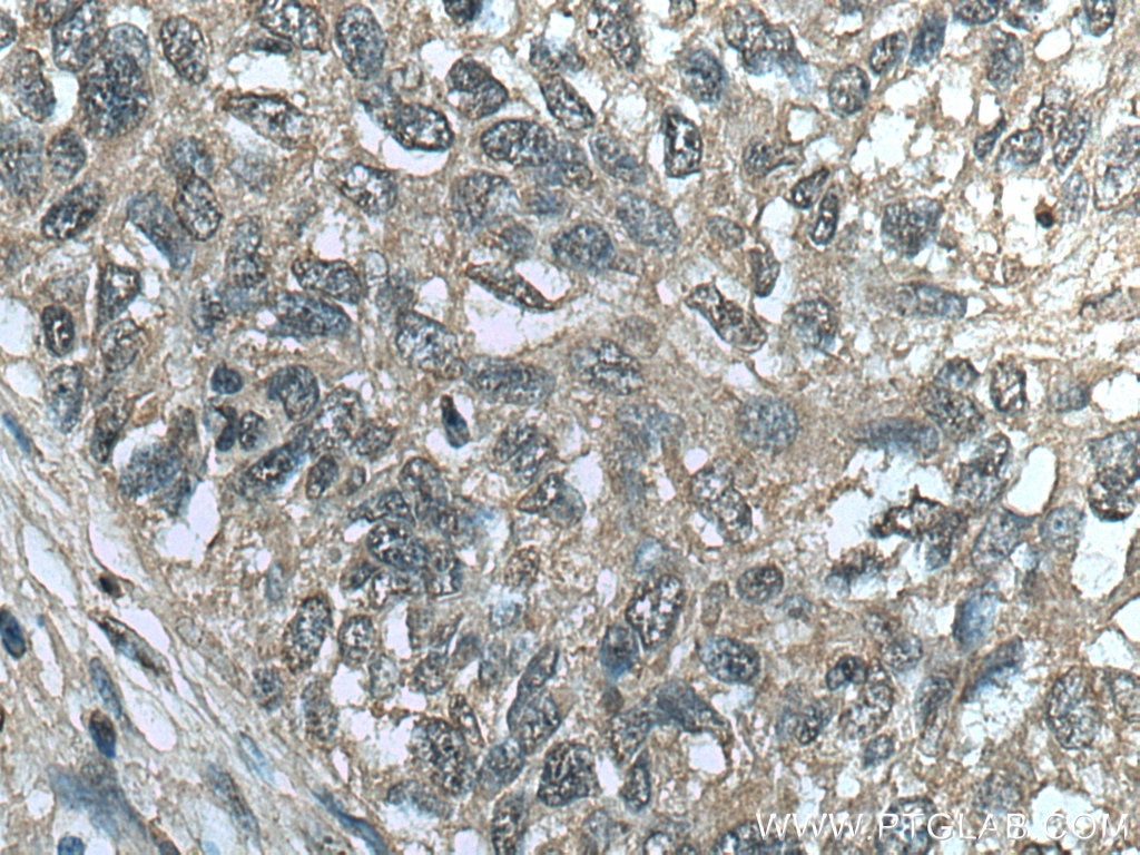 Immunohistochemistry (IHC) staining of human lung cancer tissue using CDCA5 Monoclonal antibody (67418-1-Ig)