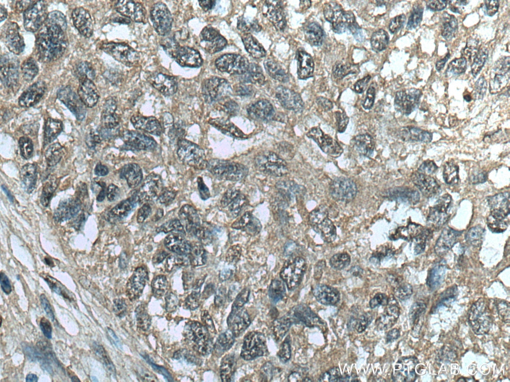 IHC staining of human lung cancer using 67418-1-Ig