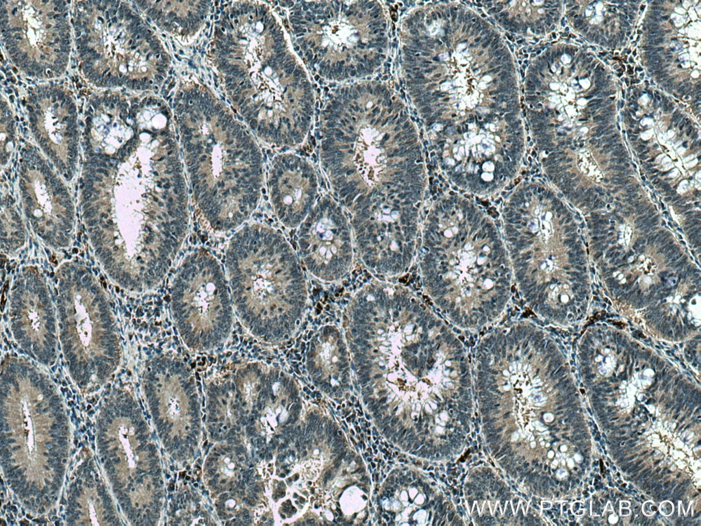 IHC staining of human colon cancer using 67418-1-Ig