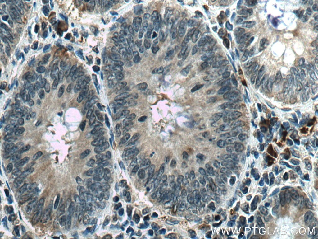 Immunohistochemistry (IHC) staining of human colon cancer tissue using CDCA5 Monoclonal antibody (67418-1-Ig)
