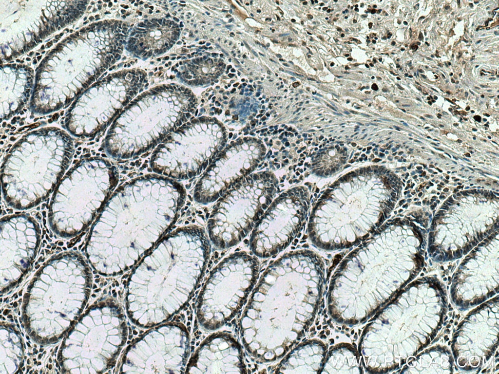 Immunohistochemistry (IHC) staining of human colon cancer tissue using CDCA5 Monoclonal antibody (67418-1-Ig)