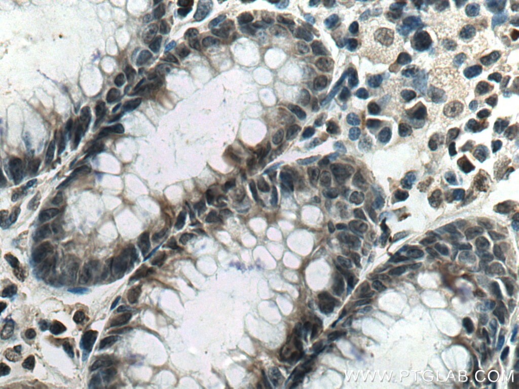 Immunohistochemistry (IHC) staining of human colon cancer tissue using CDCA5 Monoclonal antibody (67418-1-Ig)