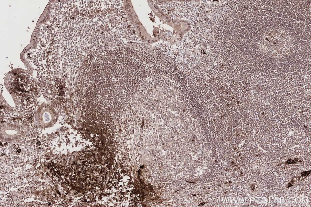 Immunohistochemistry (IHC) staining of human appendicitis tissue using CDCA5 Monoclonal antibody (67418-1-Ig)