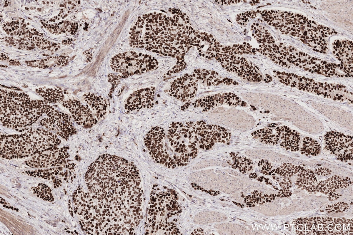 Immunohistochemistry (IHC) staining of human stomach cancer tissue using CDCA5 Monoclonal antibody (67418-1-Ig)