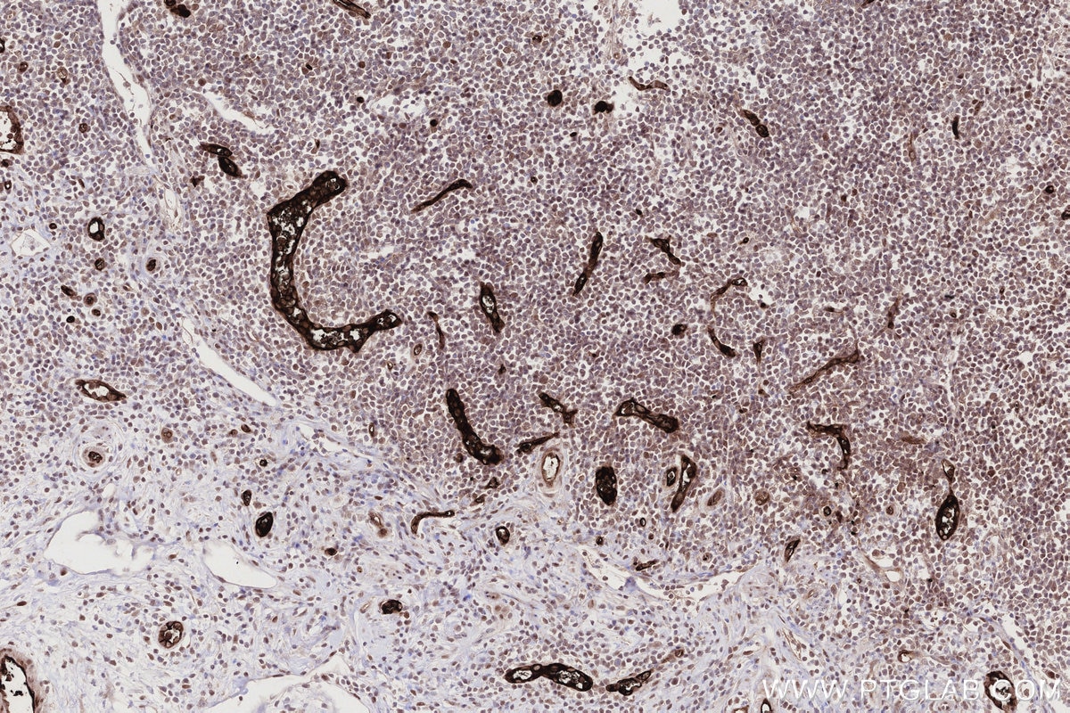 Immunohistochemistry (IHC) staining of human appendicitis tissue using CDCA5 Monoclonal antibody (67418-1-Ig)