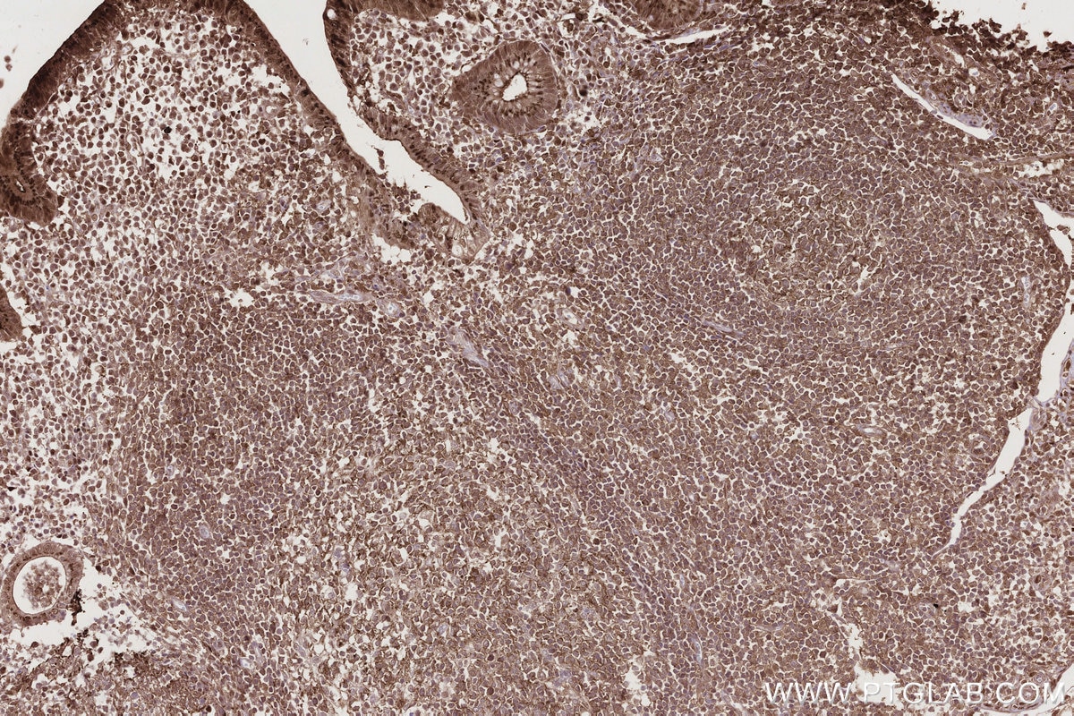 Immunohistochemistry (IHC) staining of human appendicitis tissue using CDCA7L Recombinant monoclonal antibody (83682-4-RR)