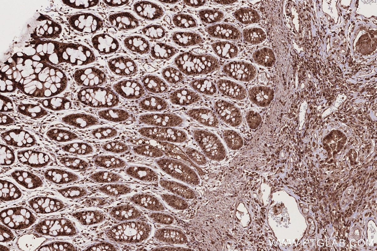Immunohistochemistry (IHC) staining of human rectal cancer tissue using CDCA7L Recombinant monoclonal antibody (83682-4-RR)