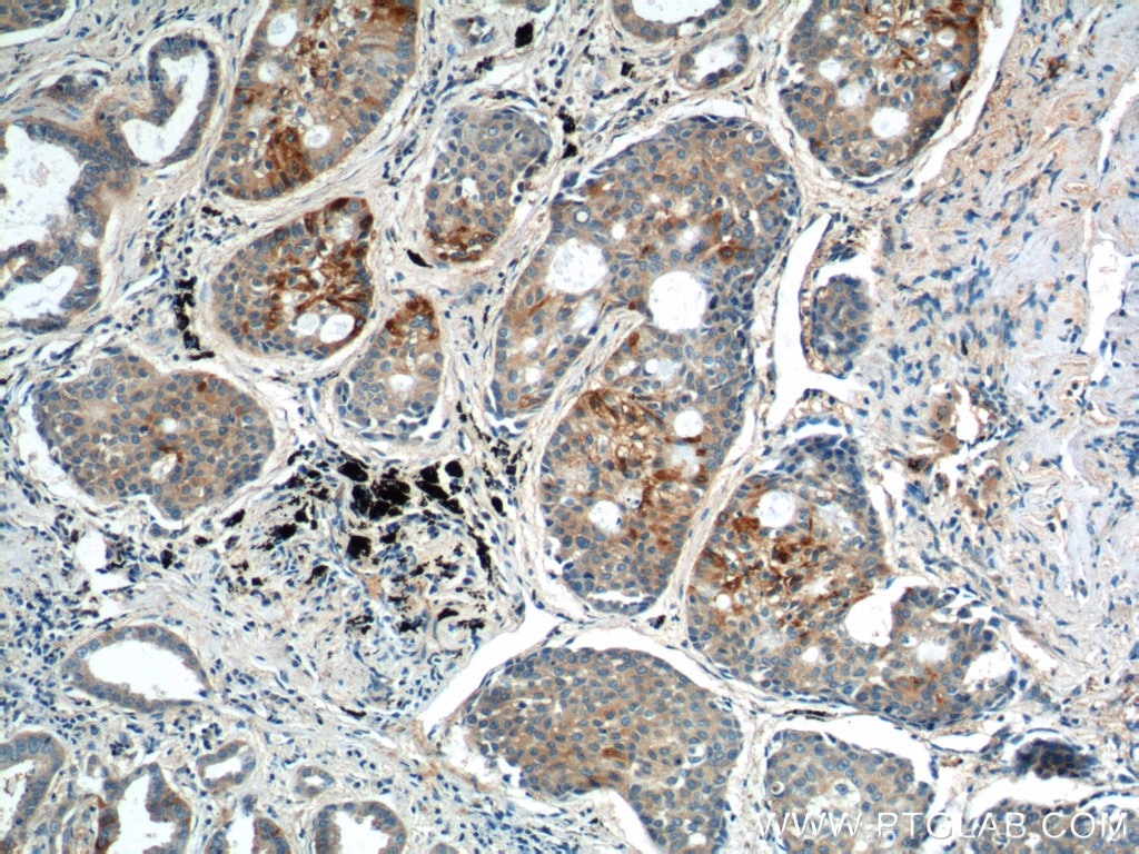 Immunohistochemistry (IHC) staining of human lung cancer tissue using CDCA8 Polyclonal antibody (12465-1-AP)