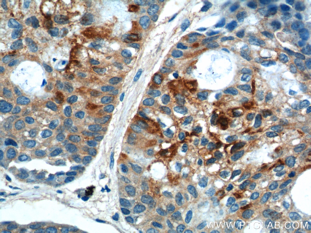 Immunohistochemistry (IHC) staining of human lung cancer tissue using CDCA8 Polyclonal antibody (12465-1-AP)