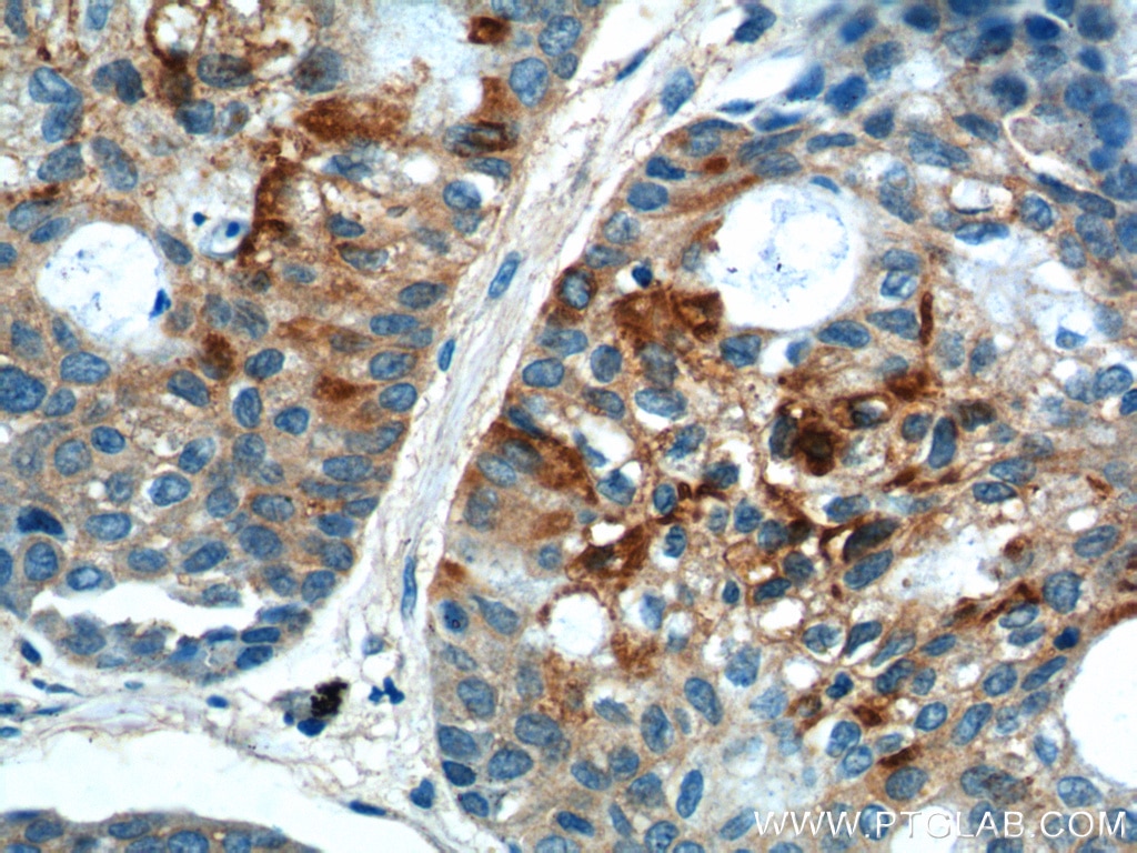 IHC staining of human lung cancer using 12465-1-AP