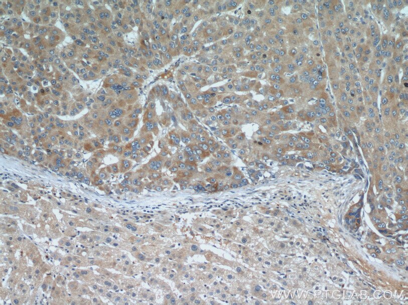 Immunohistochemistry (IHC) staining of human liver cancer tissue using E-cadherin Polyclonal antibody (20648-1-AP)