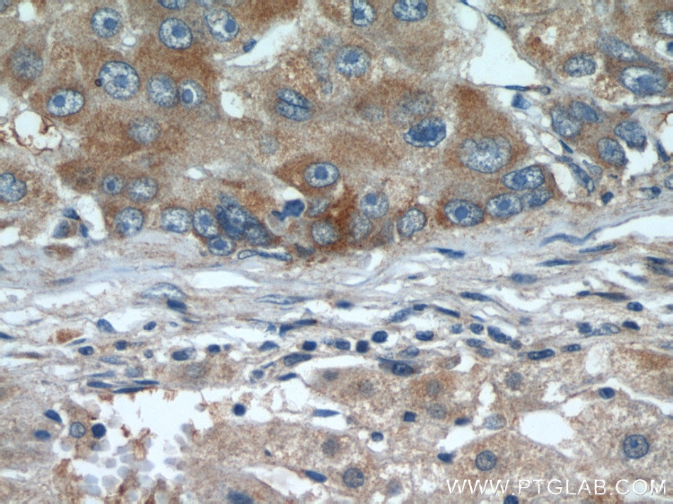 Immunohistochemistry (IHC) staining of human liver cancer tissue using E-cadherin Polyclonal antibody (20648-1-AP)
