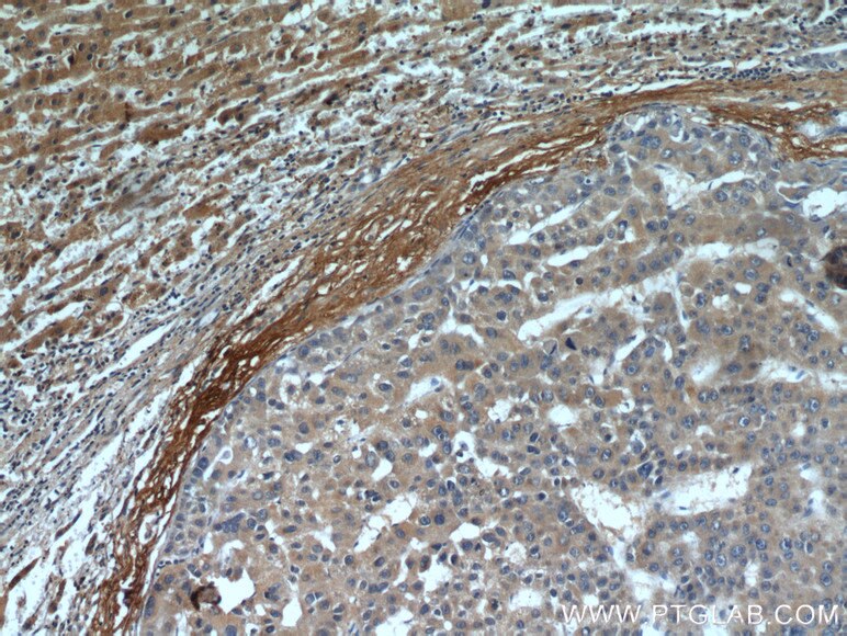 Immunohistochemistry (IHC) staining of human liver cancer tissue using E-cadherin Polyclonal antibody (20648-1-AP)