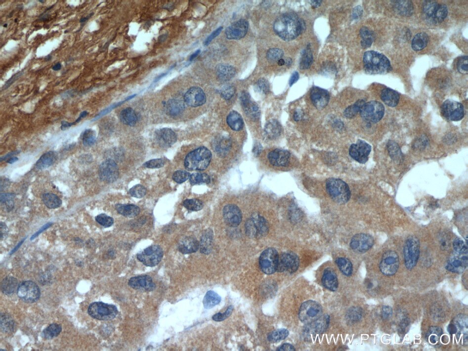 Immunohistochemistry (IHC) staining of human liver cancer tissue using E-cadherin Polyclonal antibody (20648-1-AP)