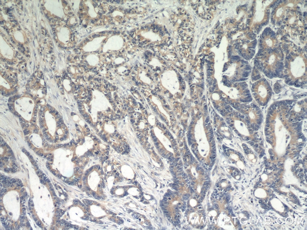 Immunohistochemistry (IHC) staining of human colon cancer tissue using E-cadherin Polyclonal antibody (20648-1-AP)