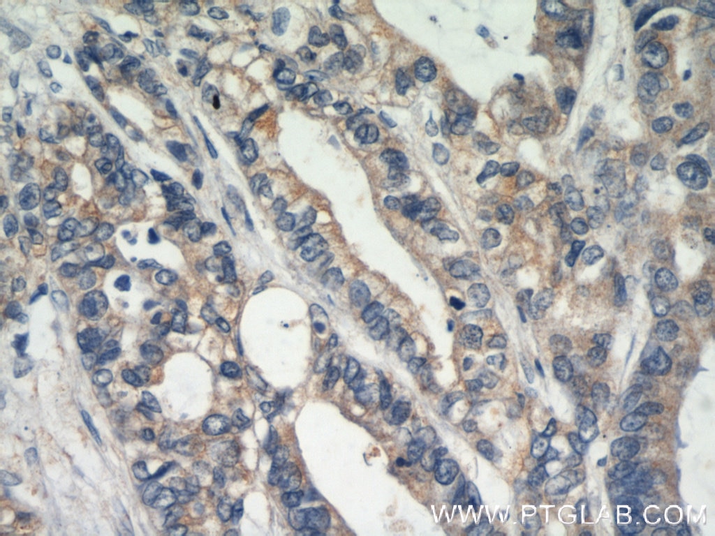IHC staining of human colon cancer using 20648-1-AP