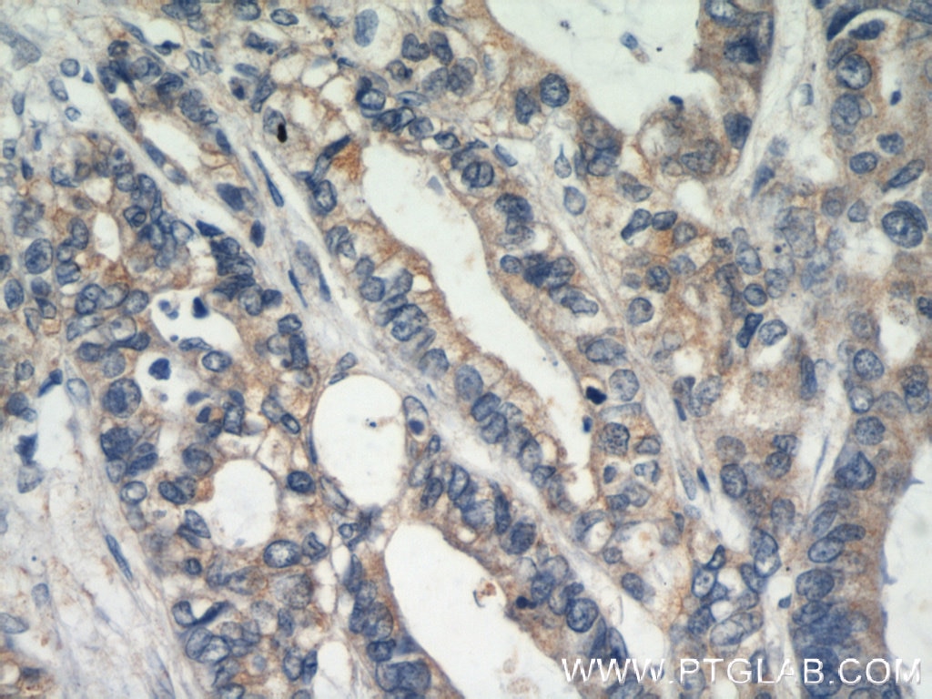 Immunohistochemistry (IHC) staining of human colon cancer tissue using E-cadherin Polyclonal antibody (20648-1-AP)